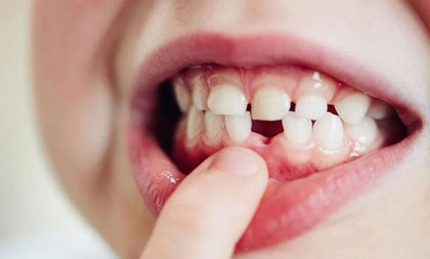 Comment reconnaître une dent de lait d’une dent définitive ? – Les ...