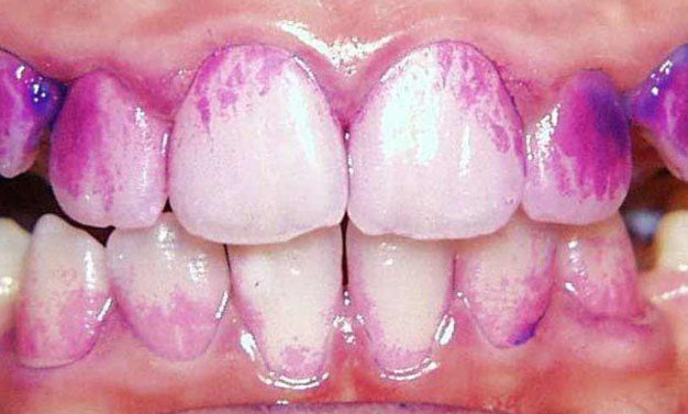 Médicaments à base de fer et colorations dentaires : faut-il s’inquiéter ?