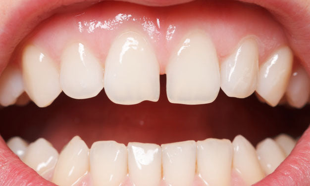 Mon enfant grince des dents la nuit (bruxisme) : faut-il s’inquiéter ?