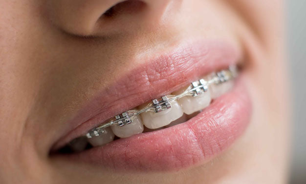 Orthodontie et Traitements pour les "Dents du Bonheur" : Un Sourire Aligné avec la Science